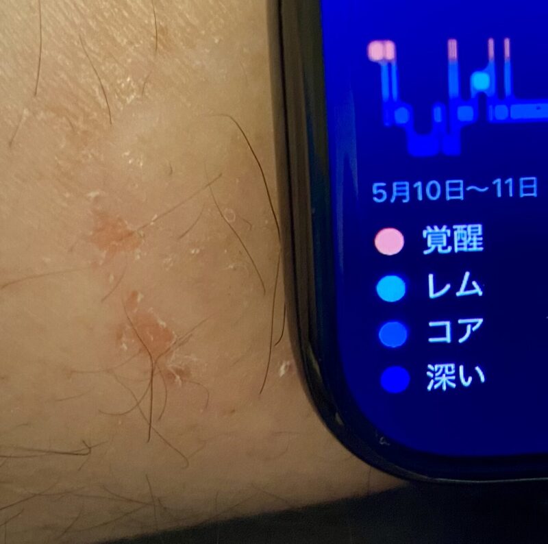 ステロイド系の薬を塗って1週間で改善・夜間はバンドを緩める運用に変更してセンサー押し付け圧を軽減