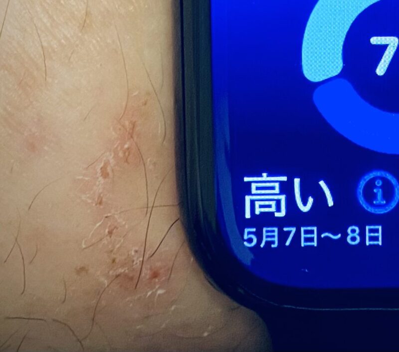 Apple Watch本体裏センサー部の押し付けによる手首のかゆみ・光学式センサー精度確保のためのトレードオフを実証